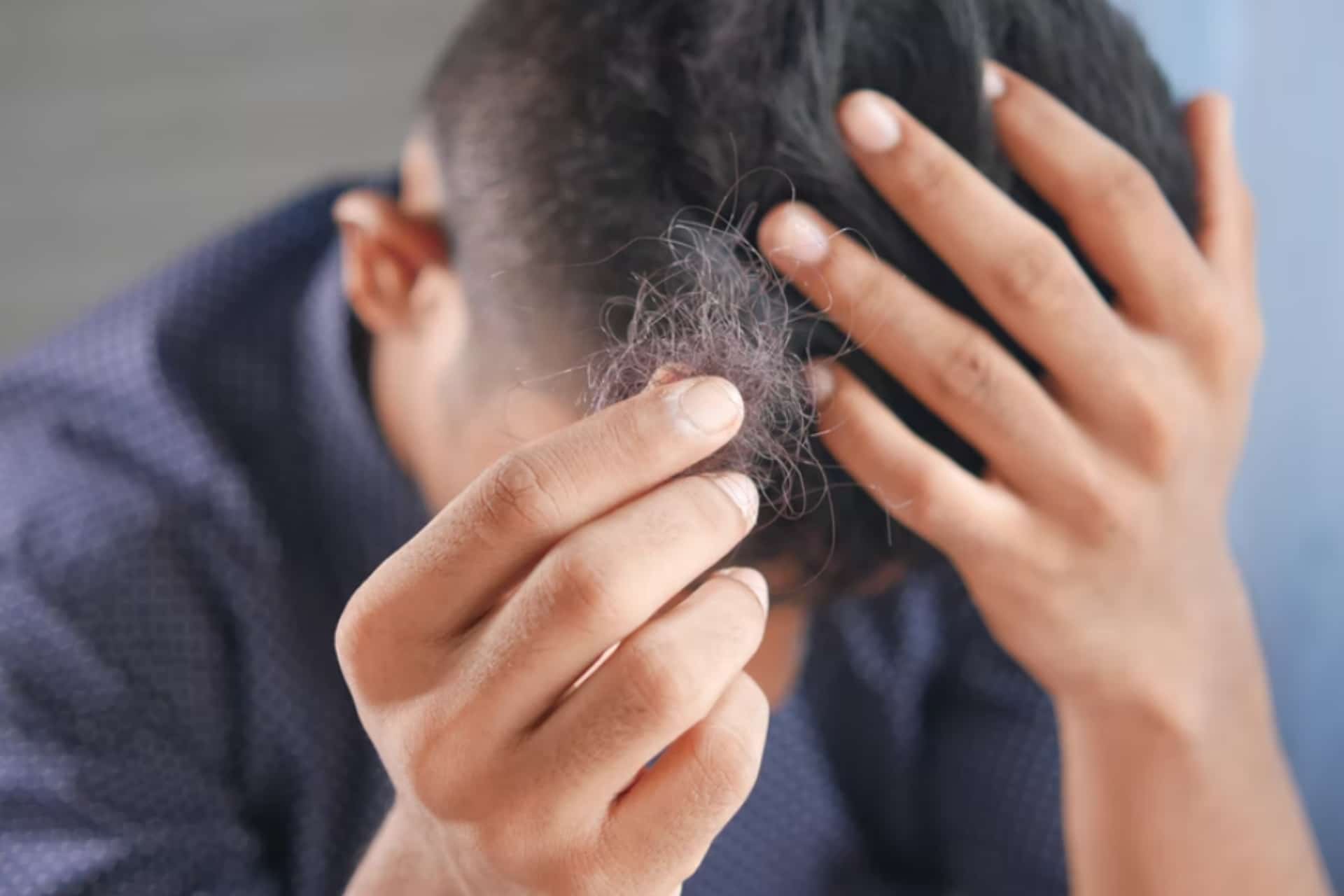 How Much Hair Loss Is Normal